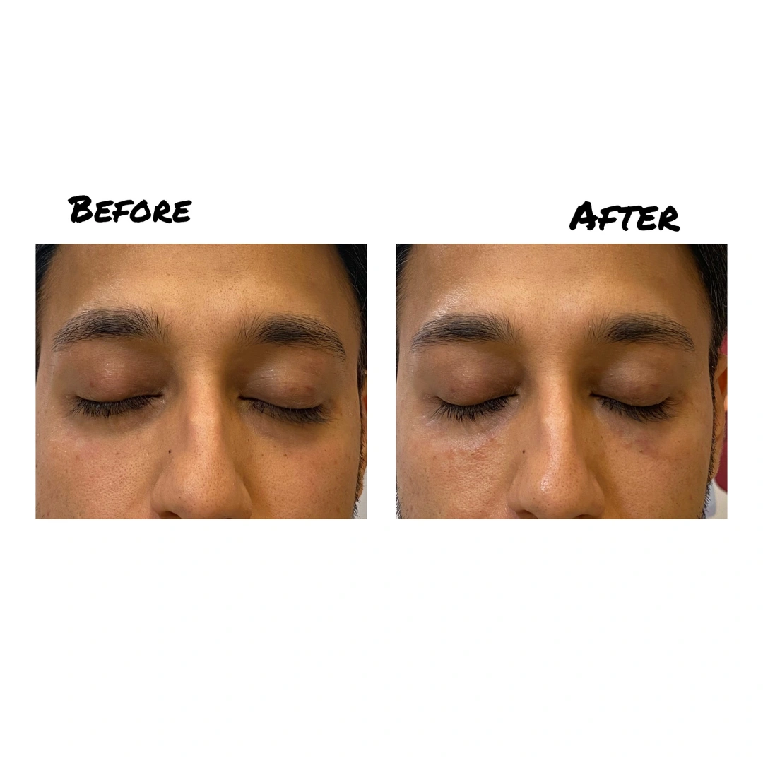 Dark Circles Treatment Before & After Results 2