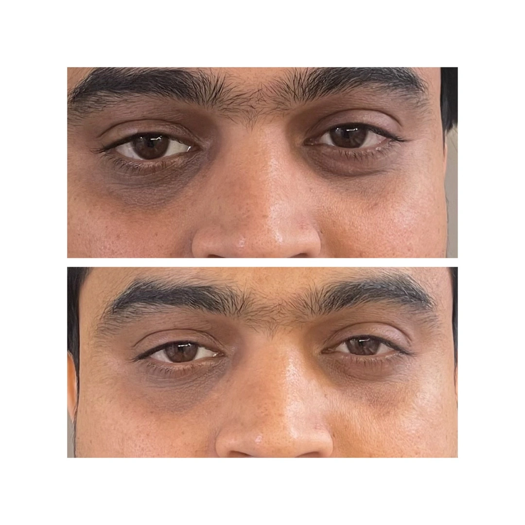 Dark Circles Treatment Before & After Results 3