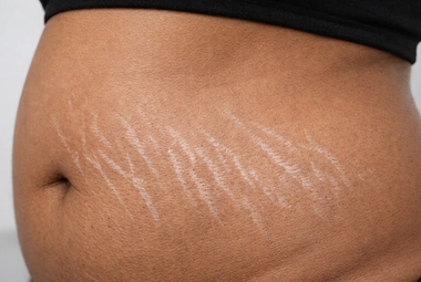 Striae Albae (White Marks)