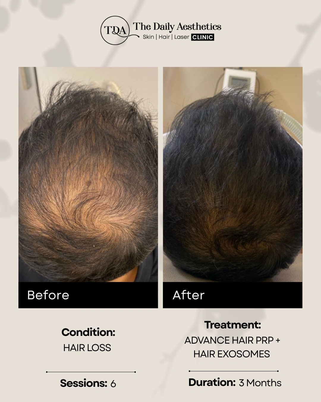 Advance Hair PRP + Hair Exosomes