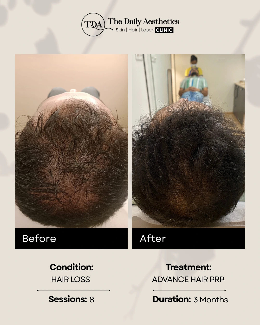 Advanced Hair PRP (2)