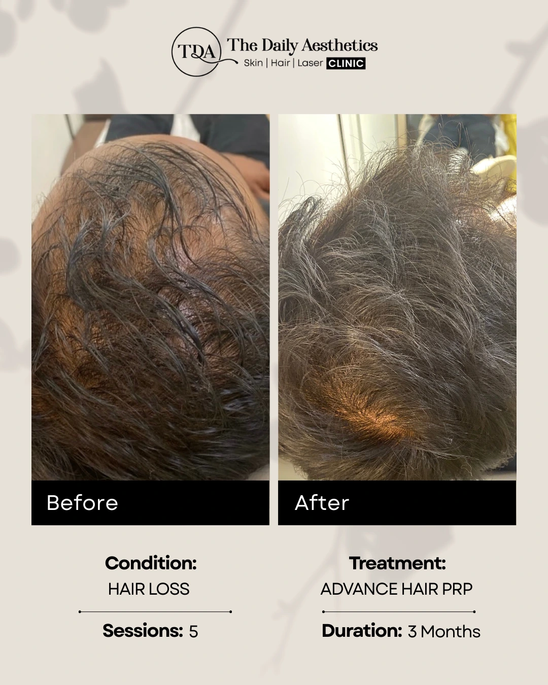 Advanced Hair PRP