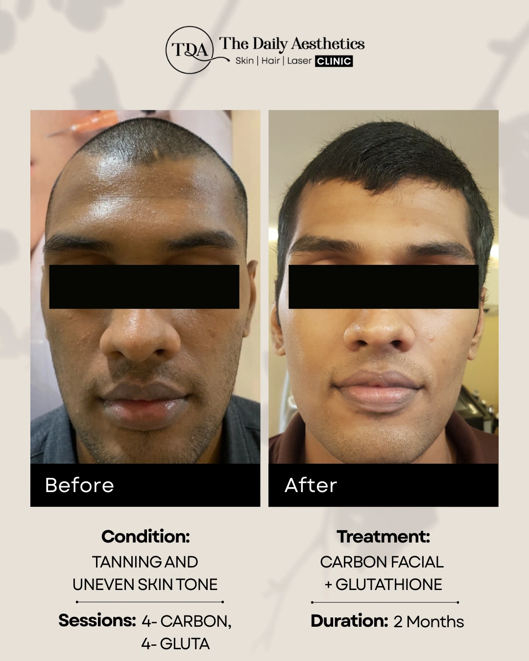 Carbon Facial + Glutathione