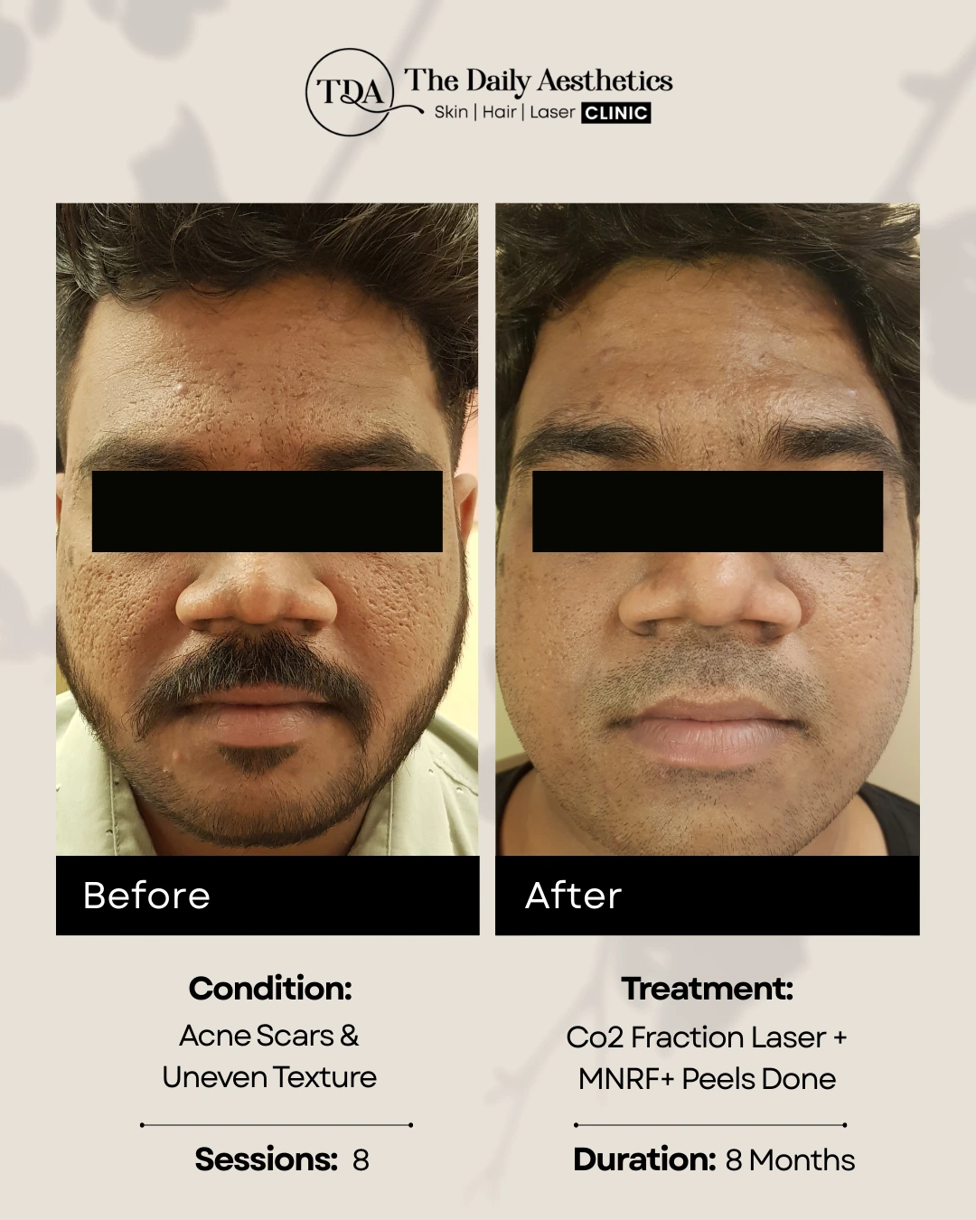 Co2 Fraction Laser + MNRF + Peels Done