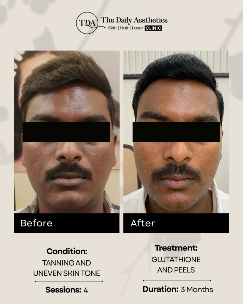 Glutathione and Peels