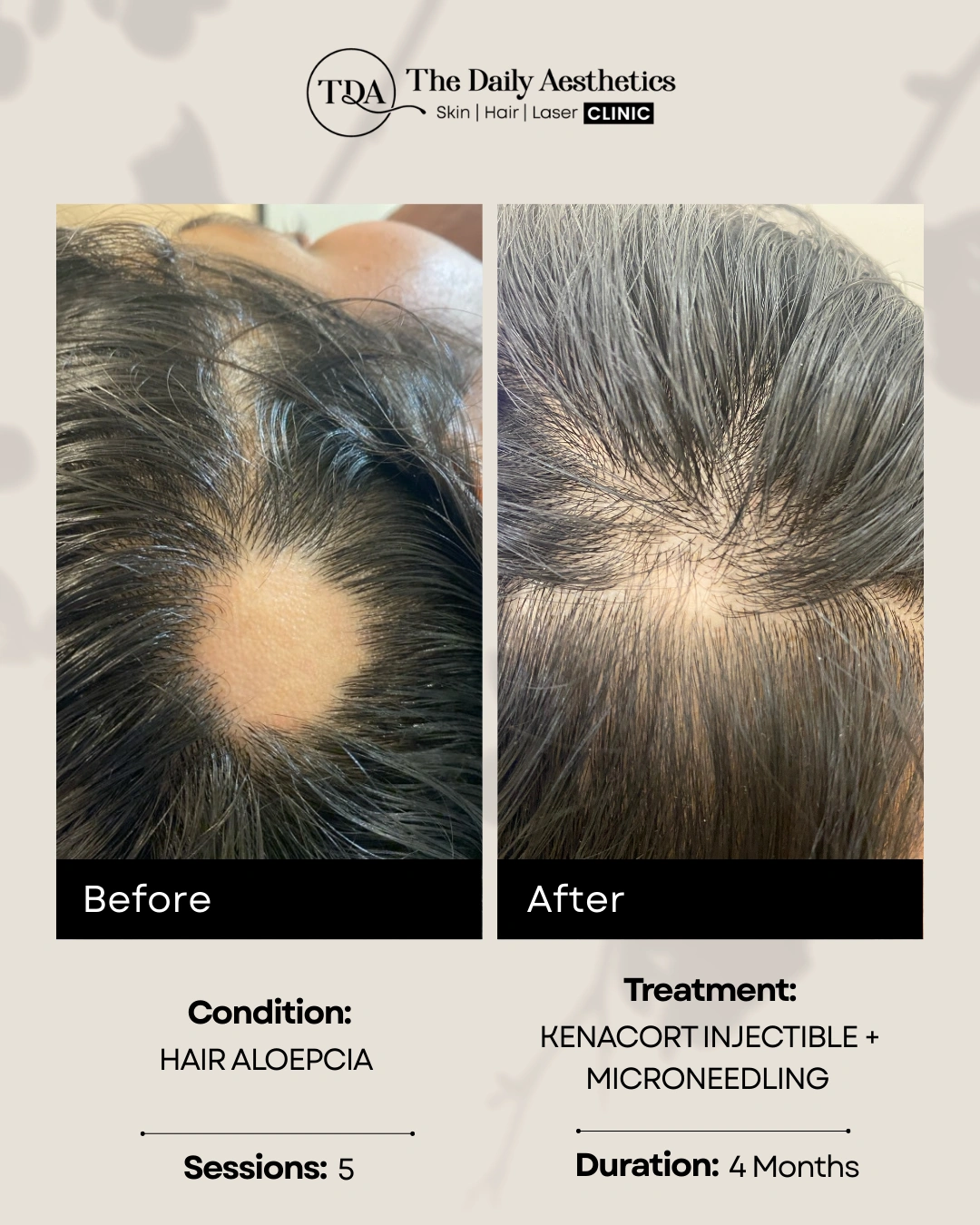 Kenacort Injectible + Microneedling Treatment