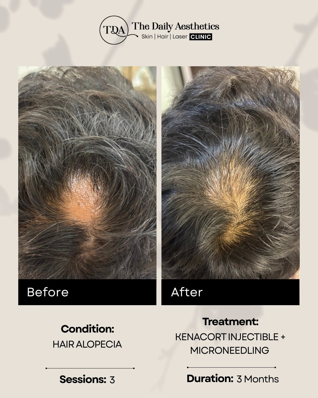 Kenacort Injectible + Microneedling