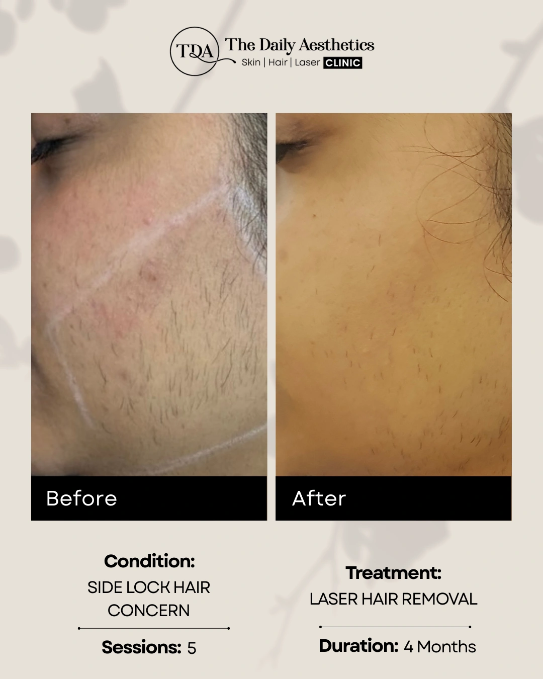 Laser Hair Removal