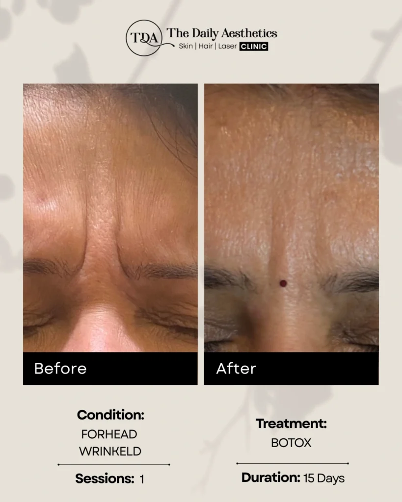 Botox (Forhead Wrinkled - 1 Sessions)
