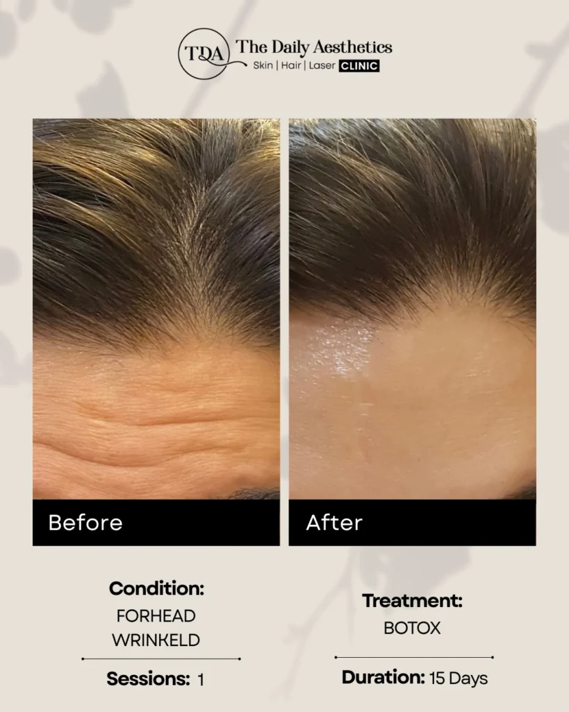 Botox (Forhead Wrinkled)