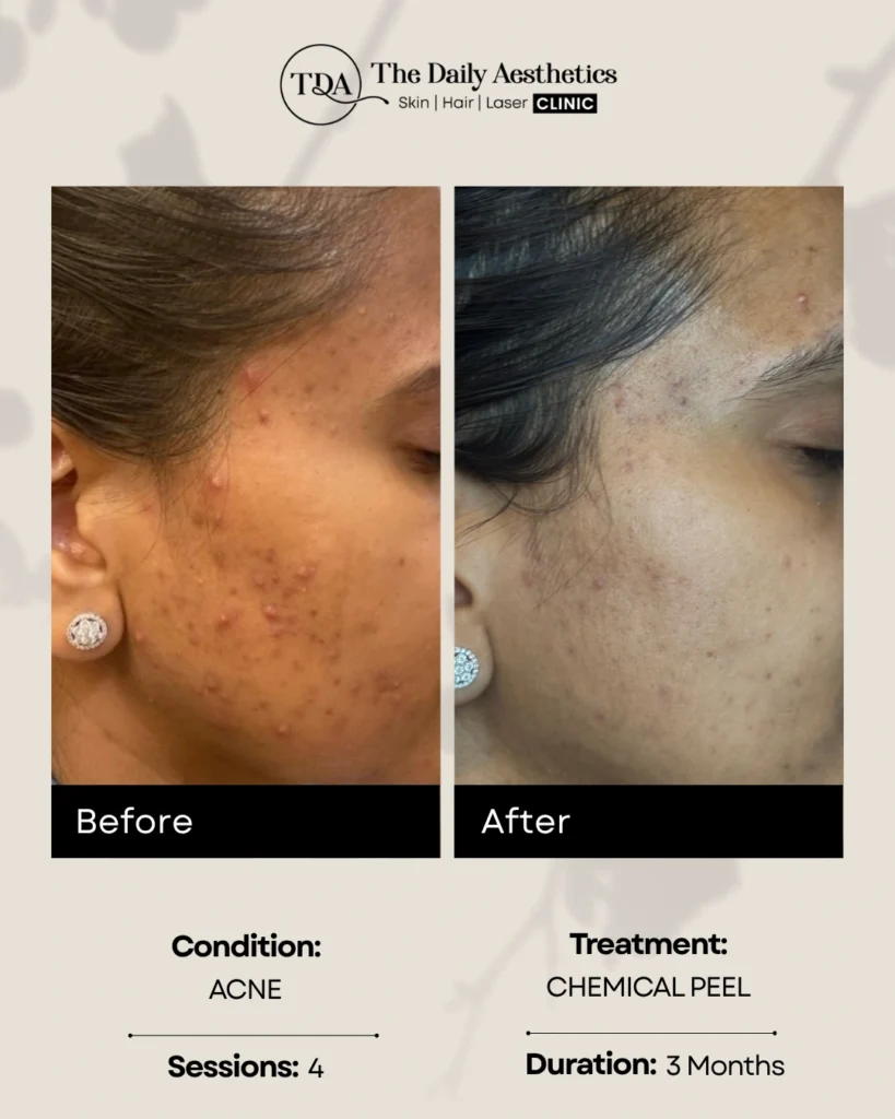 Chemical Peel (Acne - 4 Sessions)