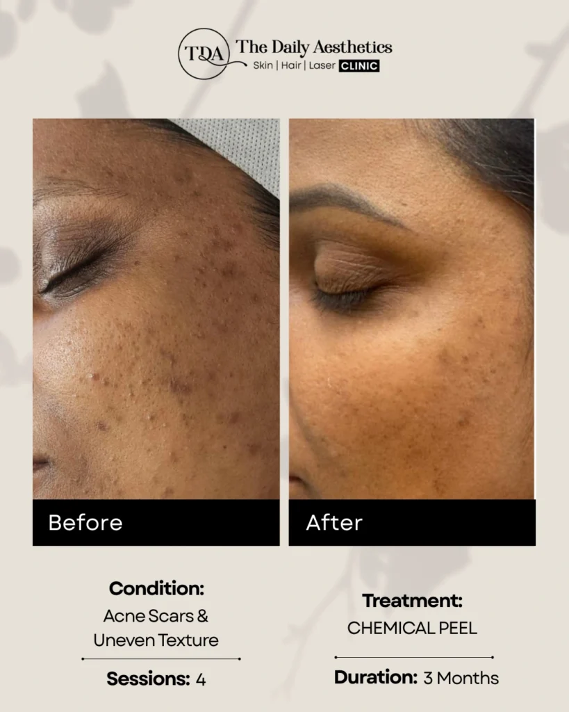 Chemical Peel (Acne Scars & Uneven Texture)