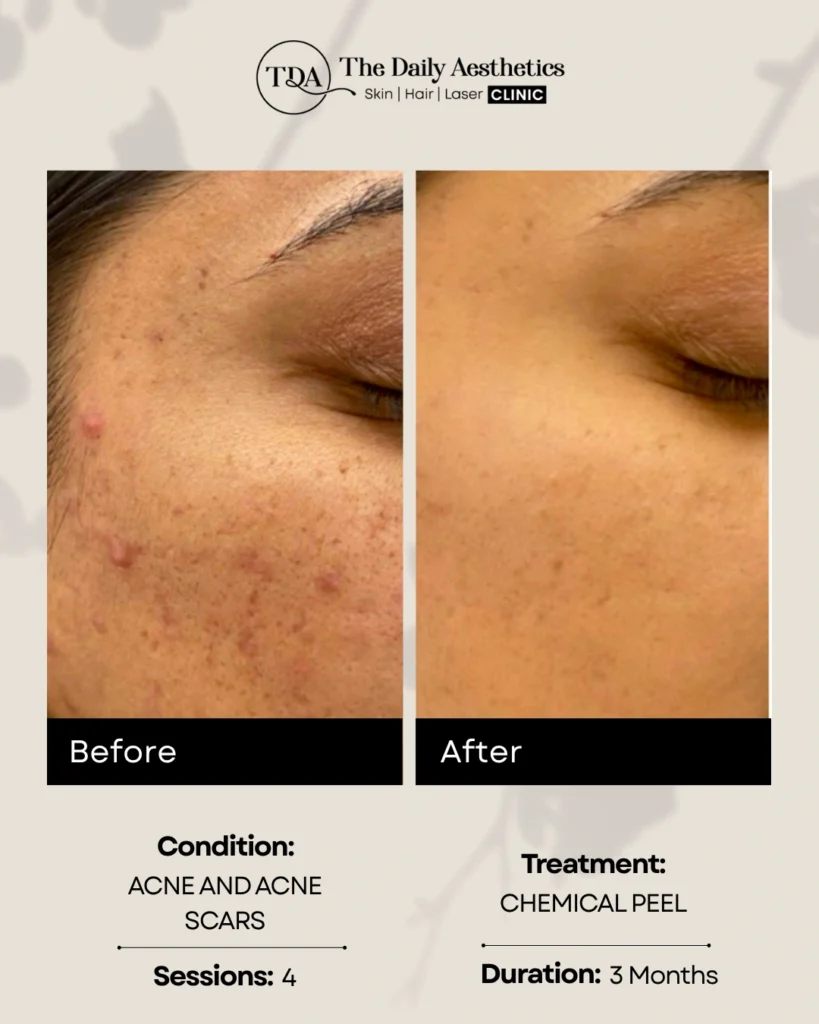 Chemical Peel (Acne and Acne Scars - 4 Sessions)