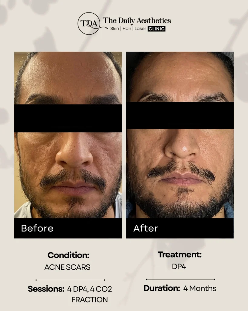 DP4 (Acne Scars)