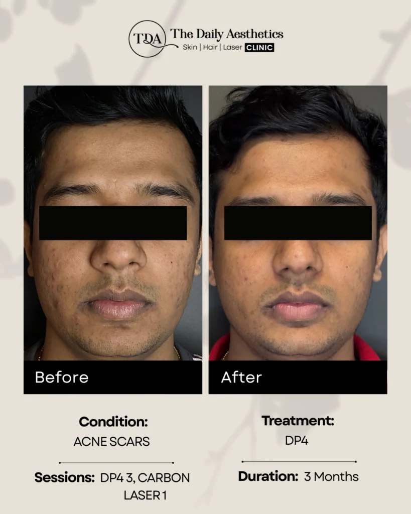 DP4 (Acne Scars - DP4 3 + Carbon Laser 1)