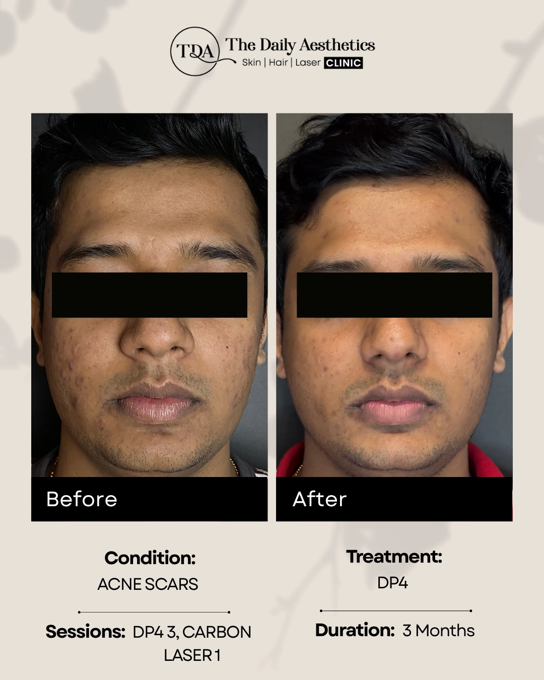 DP4 (Acne Scars - DP4 3 + Carbon Laser 1)