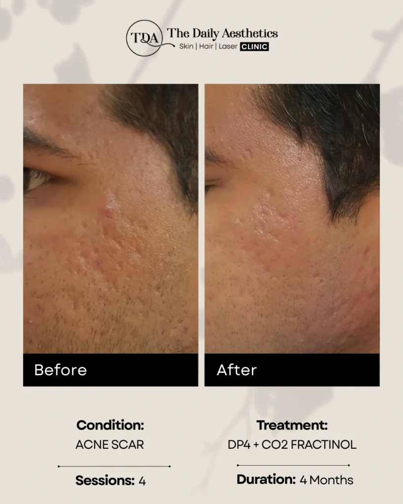 DP4 + CO2 Fractionol (Acne Scar - 4 Sessions)