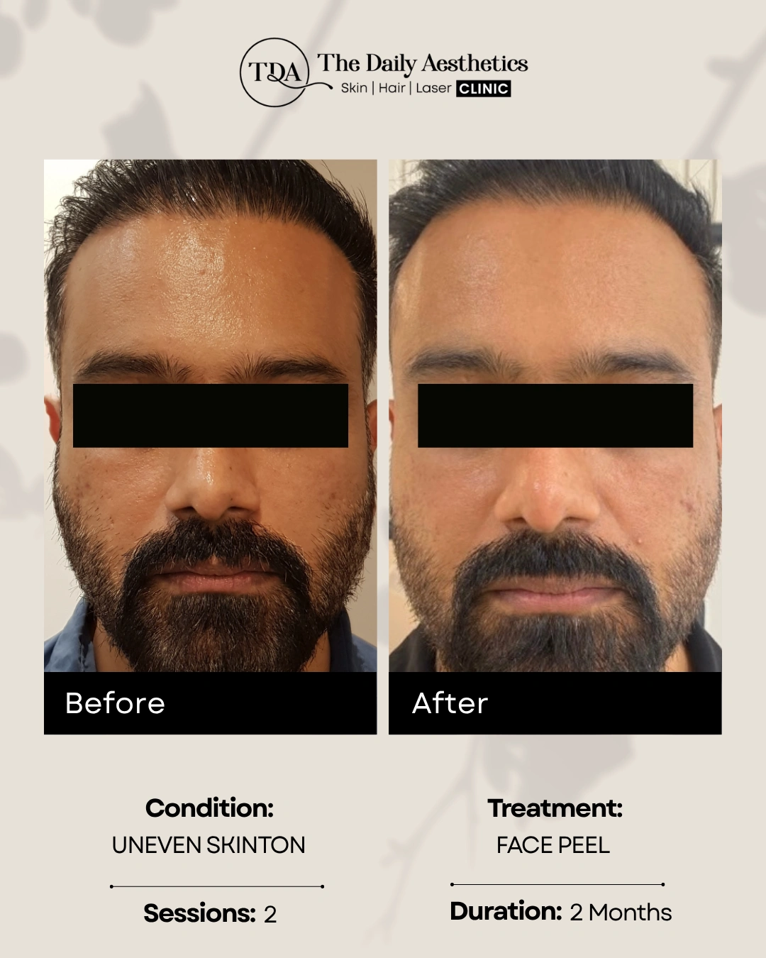 Face Peel (Uneven Skinton - 2 Sessions)