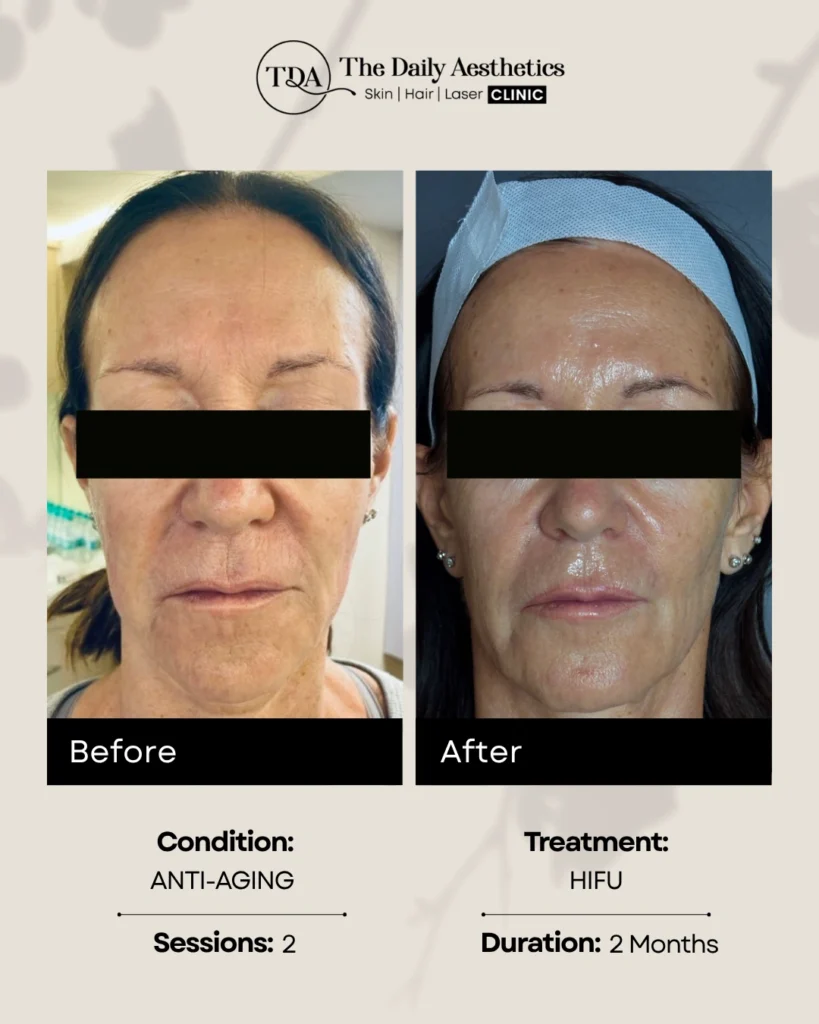 HIFU (Anti-Aging - 2 Sessions) (2)