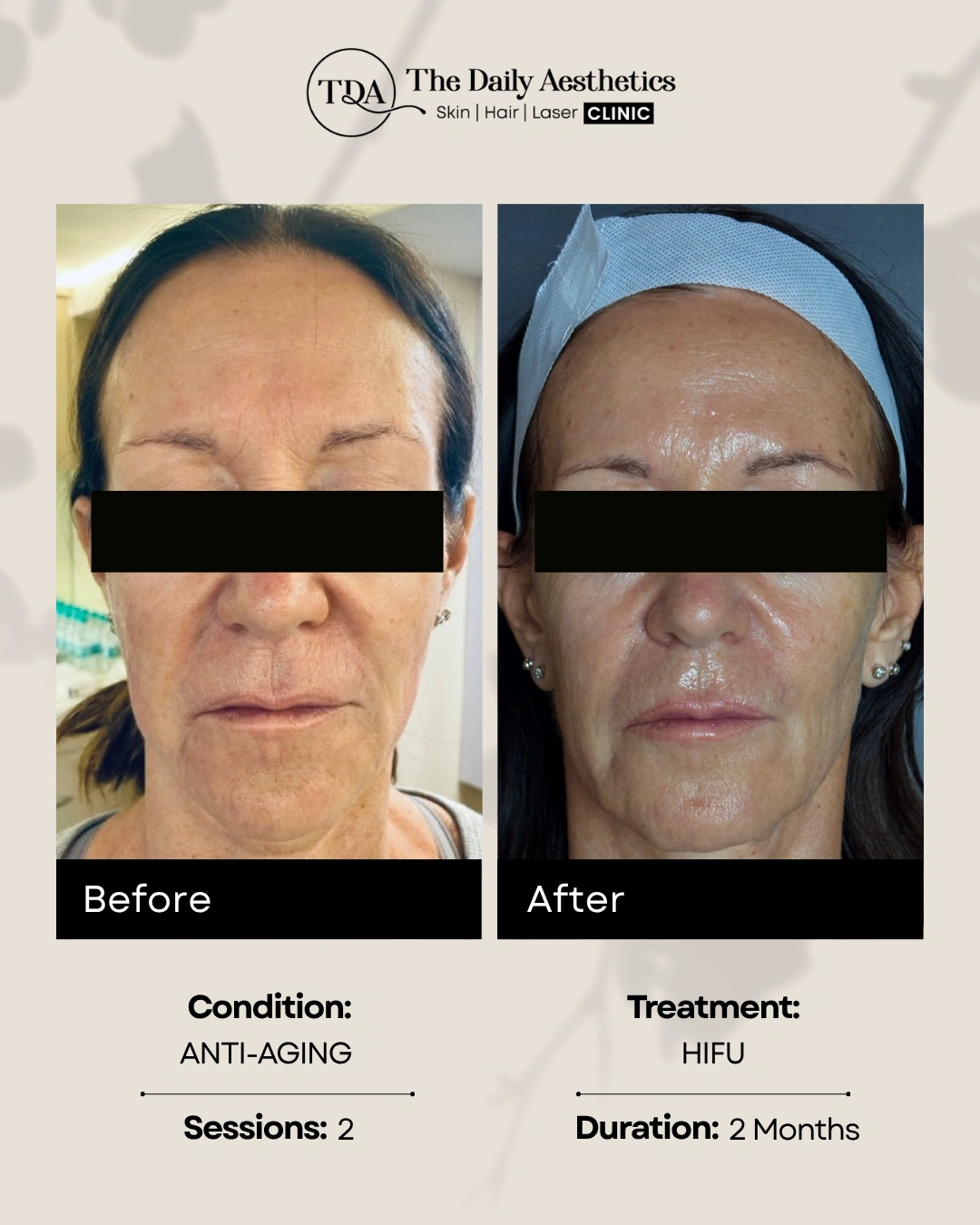 HIFU (Anti-Aging - 2 Sessions) (2)