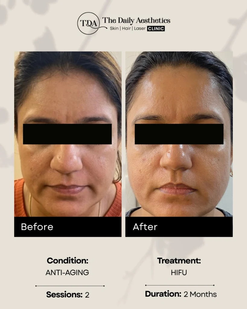 HIFU (Anti-Aging - 2 Sessions)