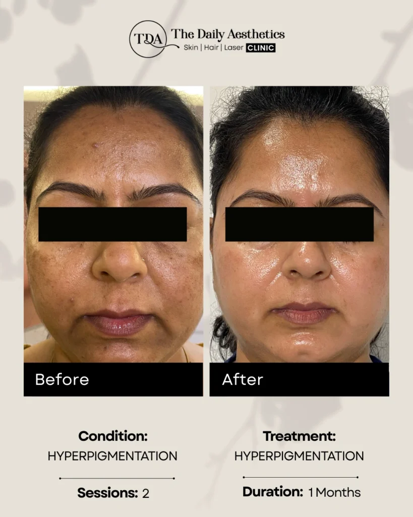 Hyperpigmentation
