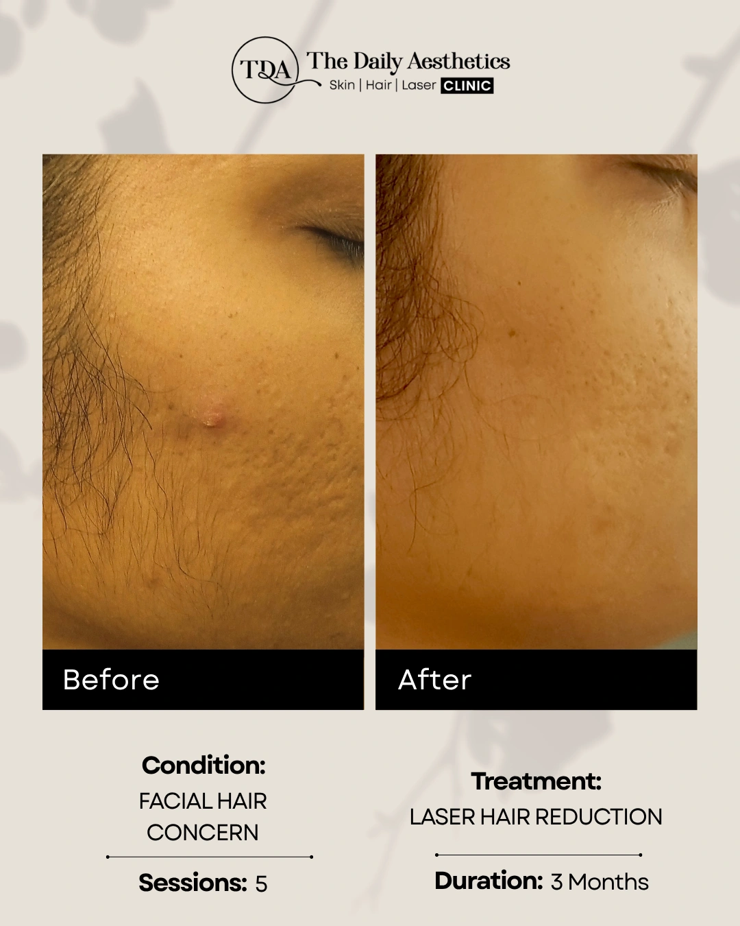 Laser Hair Reduction (Facial Hair Concern - 5 Sessions)