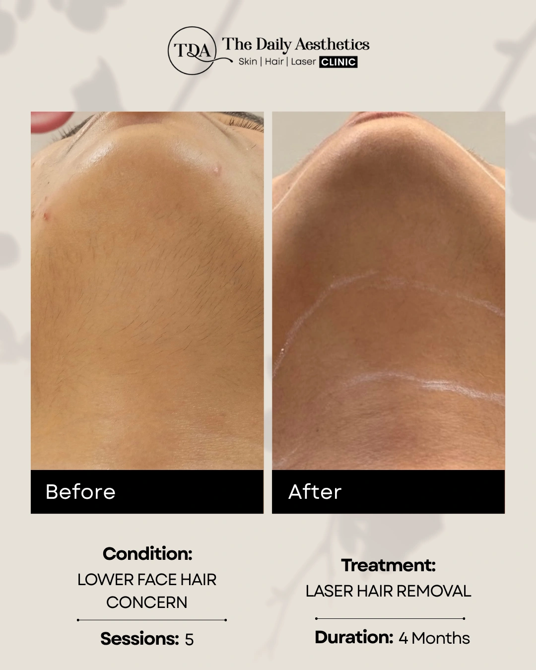 Laser Hair Removal (Lower Face Hair Concern)