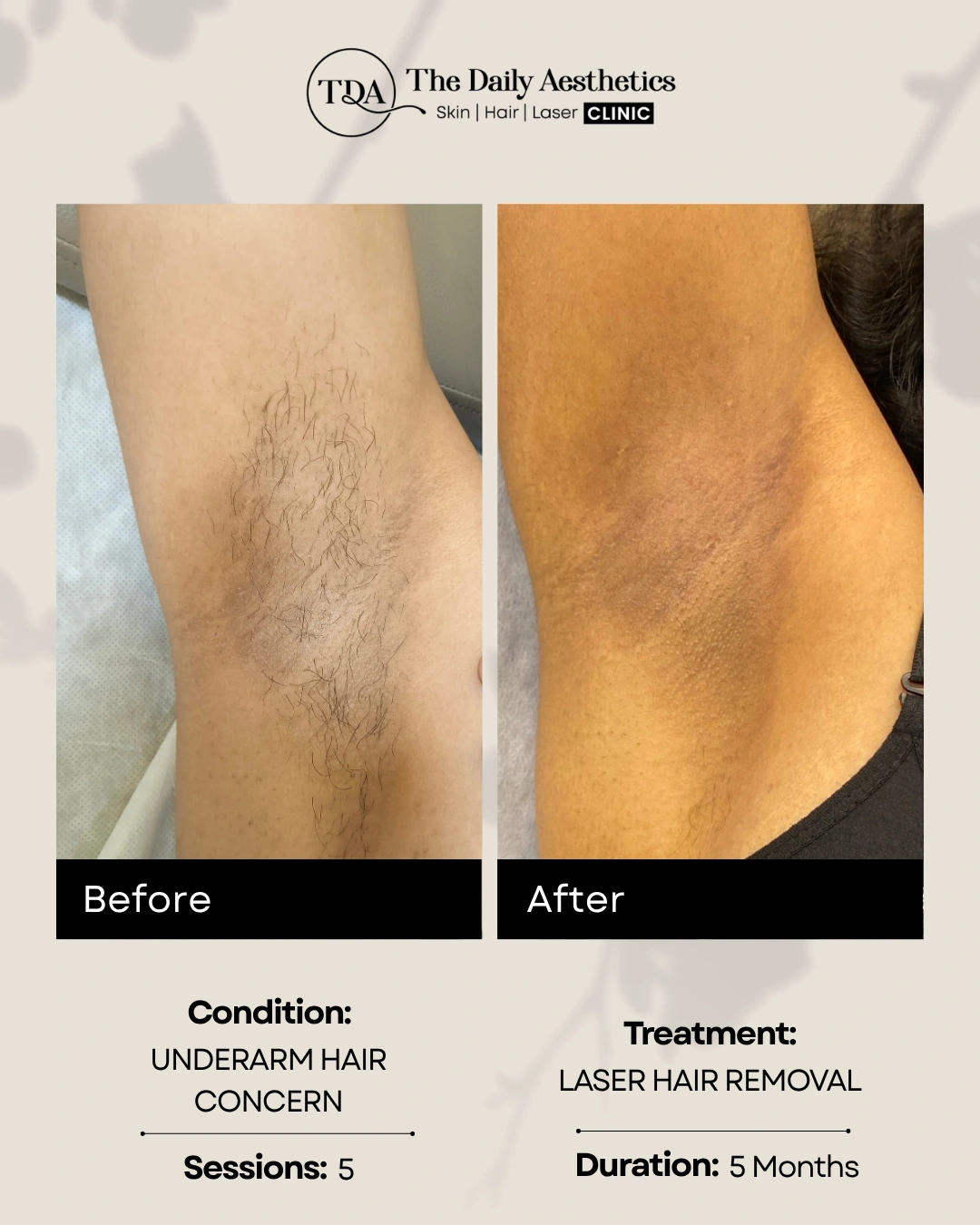 Laser Hair Removal (Underarm Hair Concern - 5 Sessions)