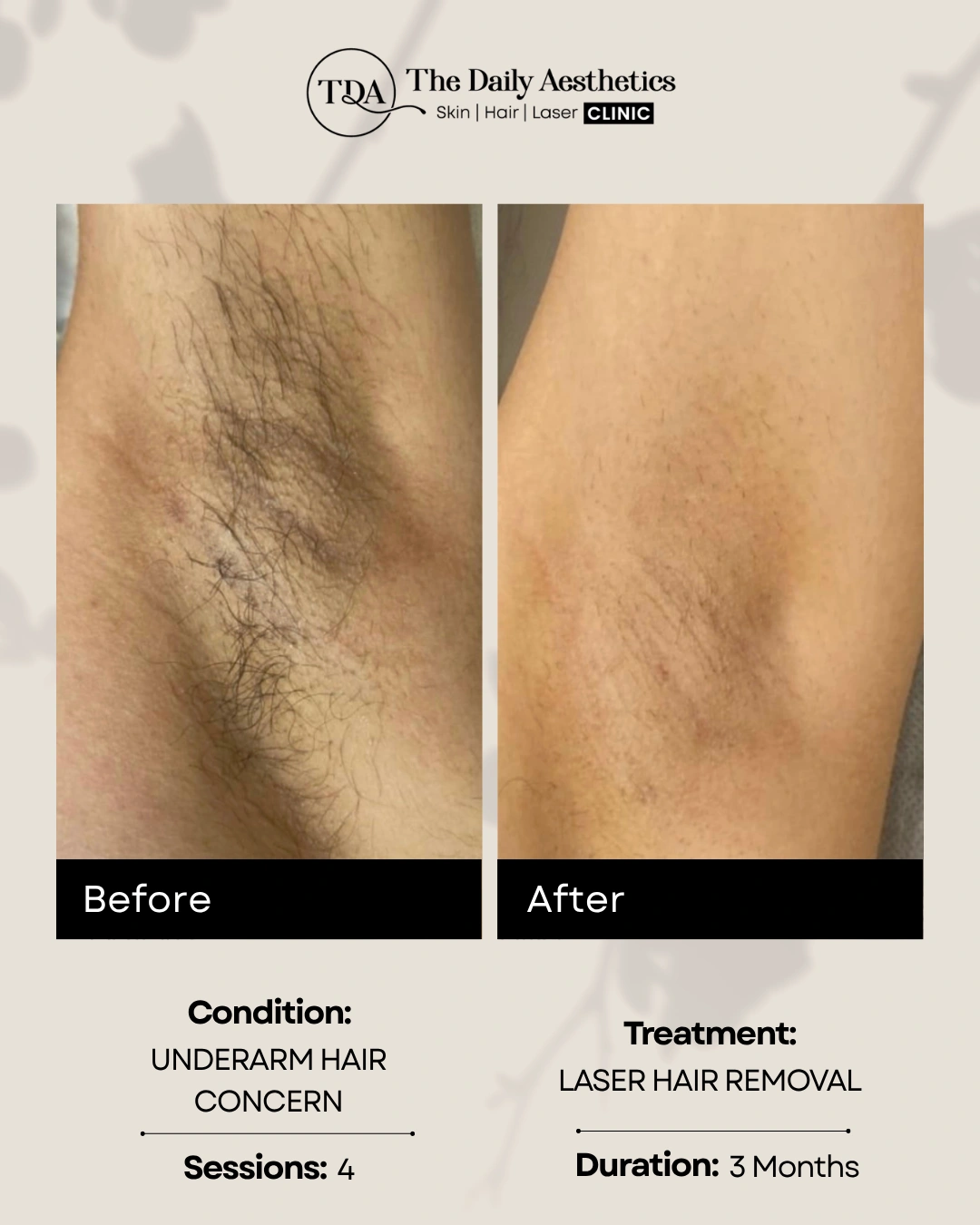Laser Hair Removal (Underarm Hair Concern)
