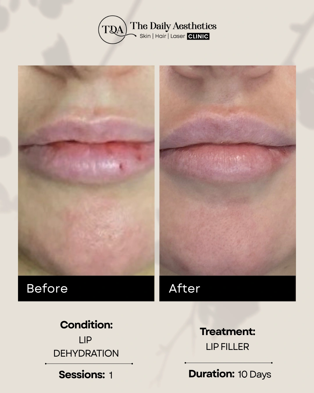 Lip Filler (Lip Dehydration - 1 Sessions)