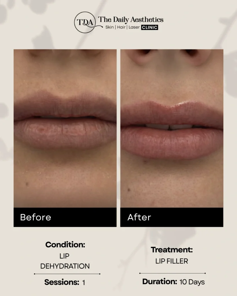 Lip Filler (Lip Dehydration)