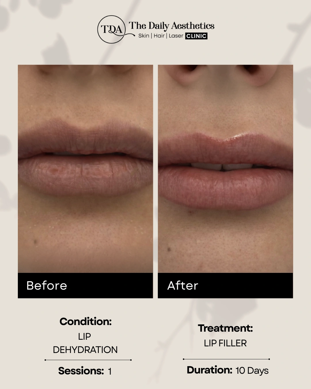 Lip Filler (Lip Dehydration)