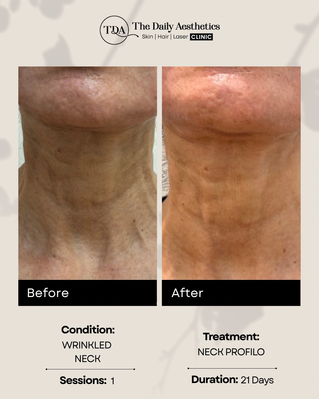 Neck Profilo (Wrinkled Neck)