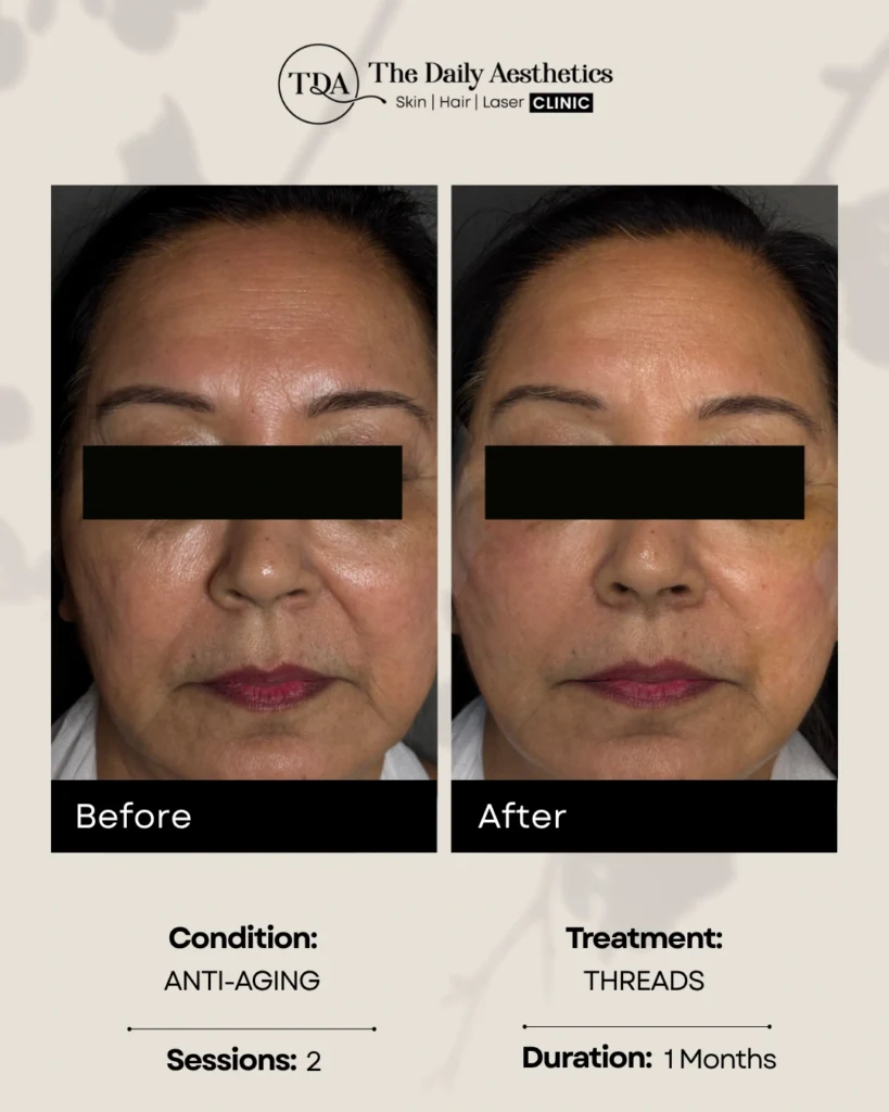 Threads (Anti-Aging - 2 Sessions)