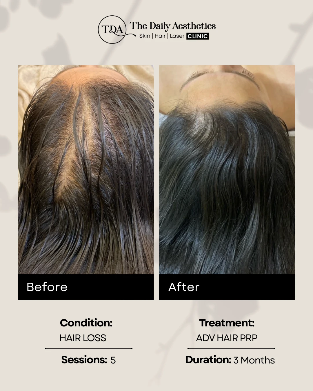 ADV Hair PRP (HairLoss)