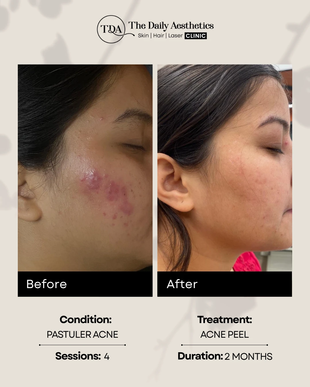 Acne Peel (Pastuler Acne) (2)