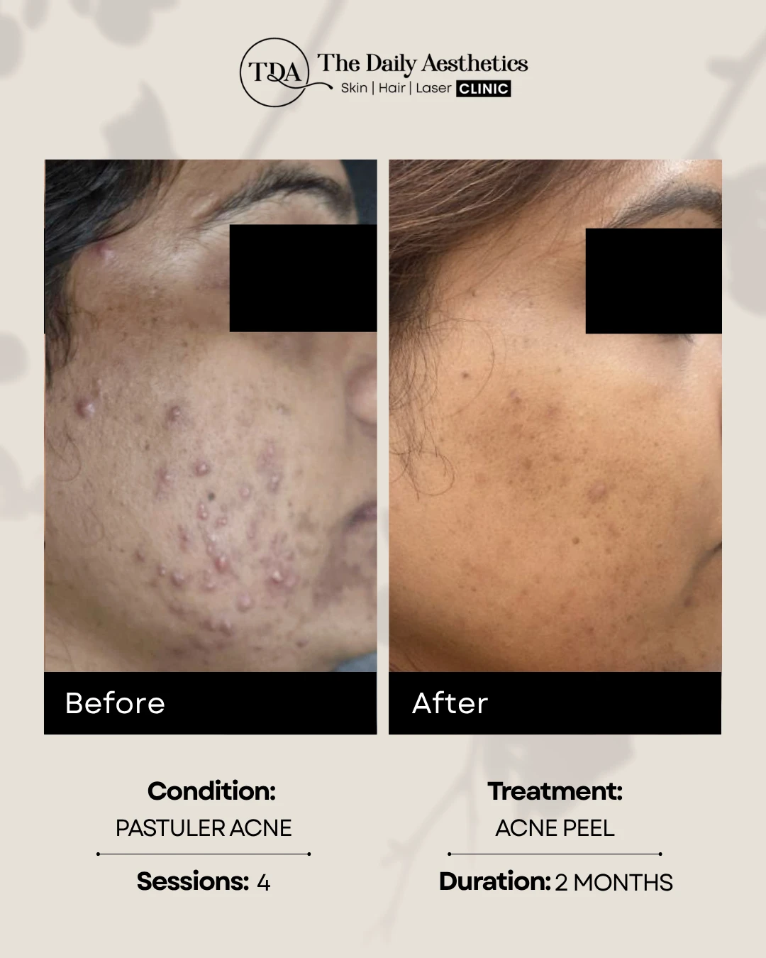 Acne Peel (Pastuler Acne) (3)