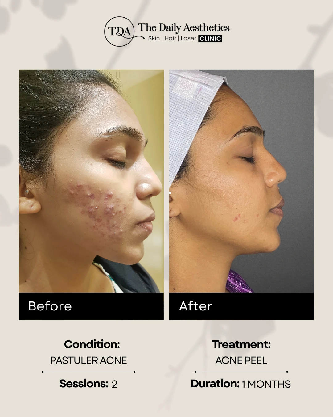 Acne Peel (Pastuler Acne)