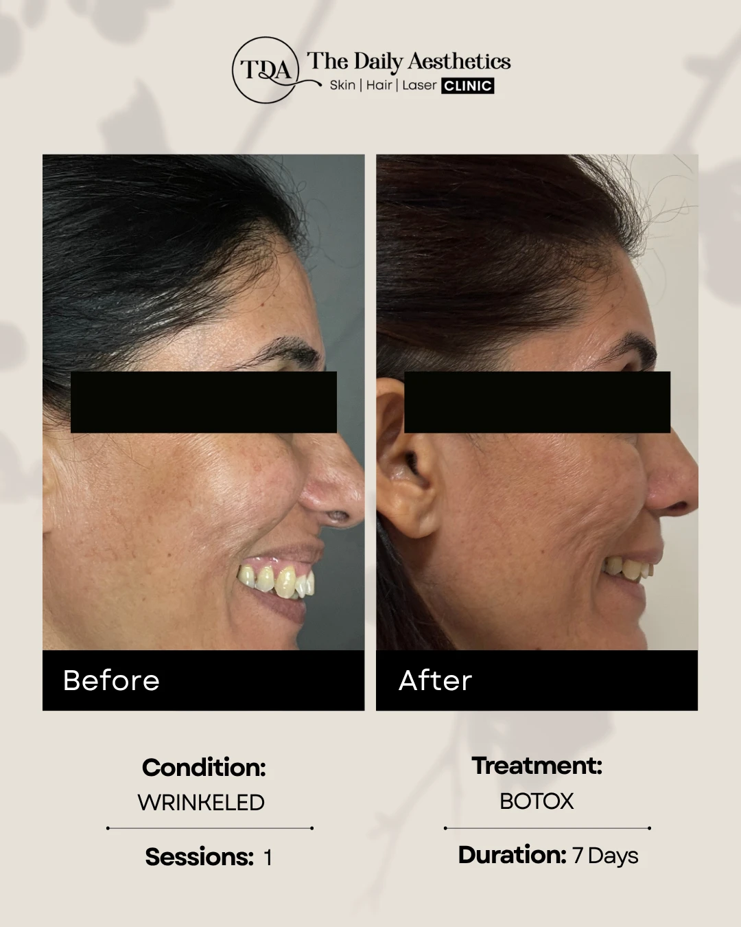 Facial Wrinkle Reduction Treatment