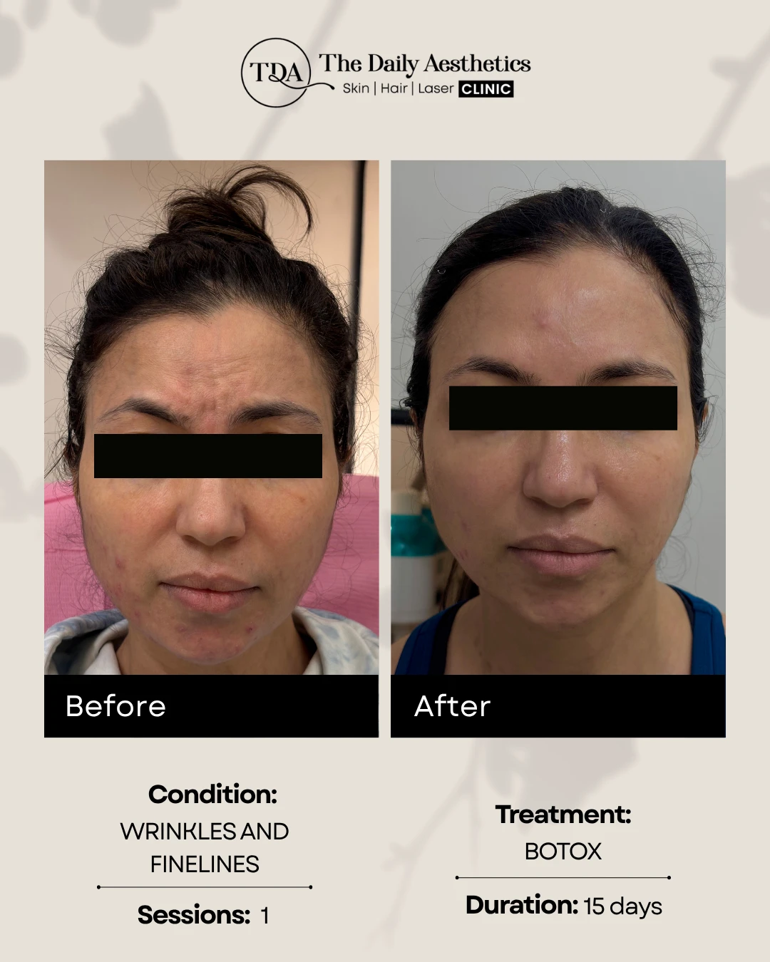 Facial Wrinkle Reduction Treatment