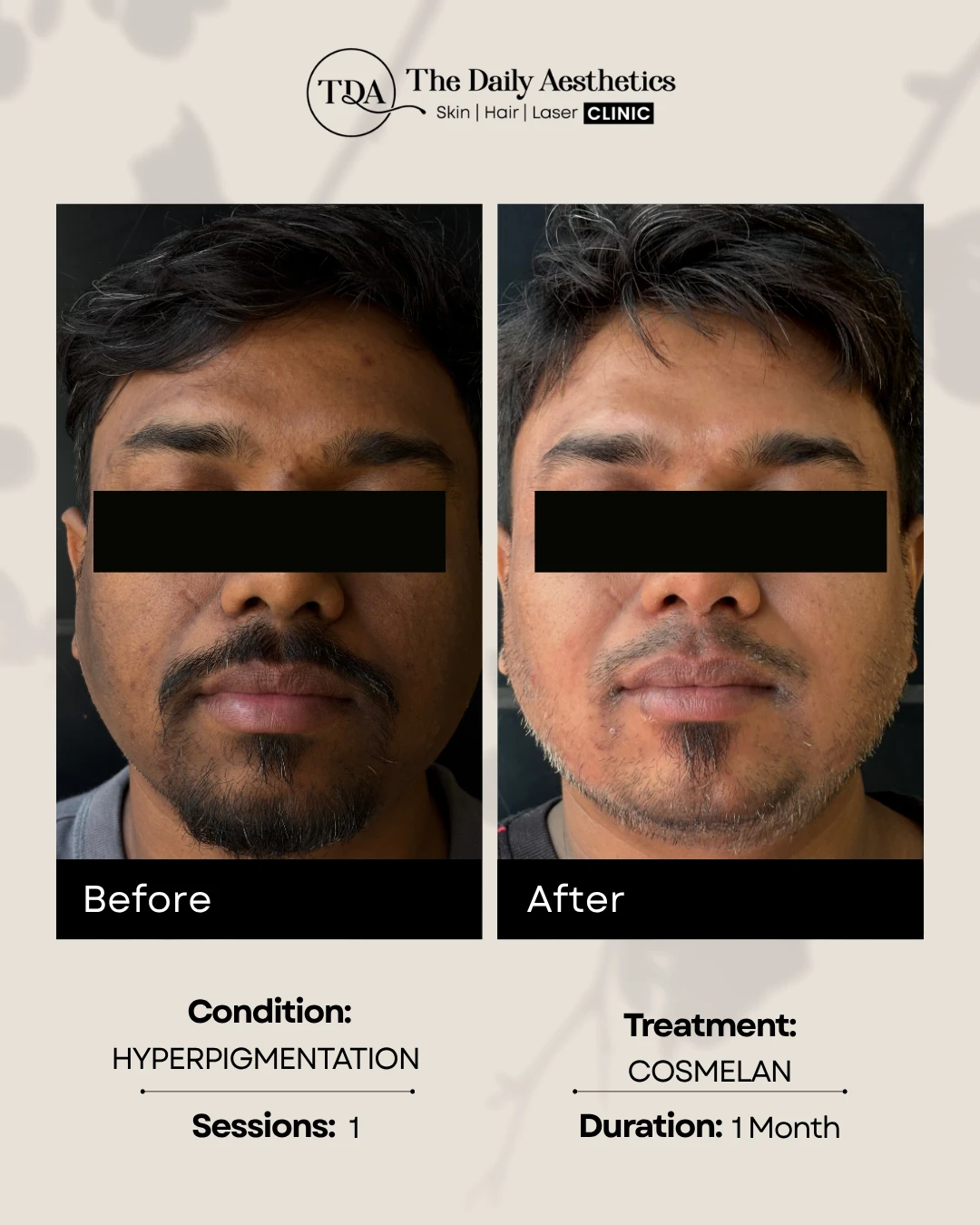 Cosmelan (Hyperpigmentation)