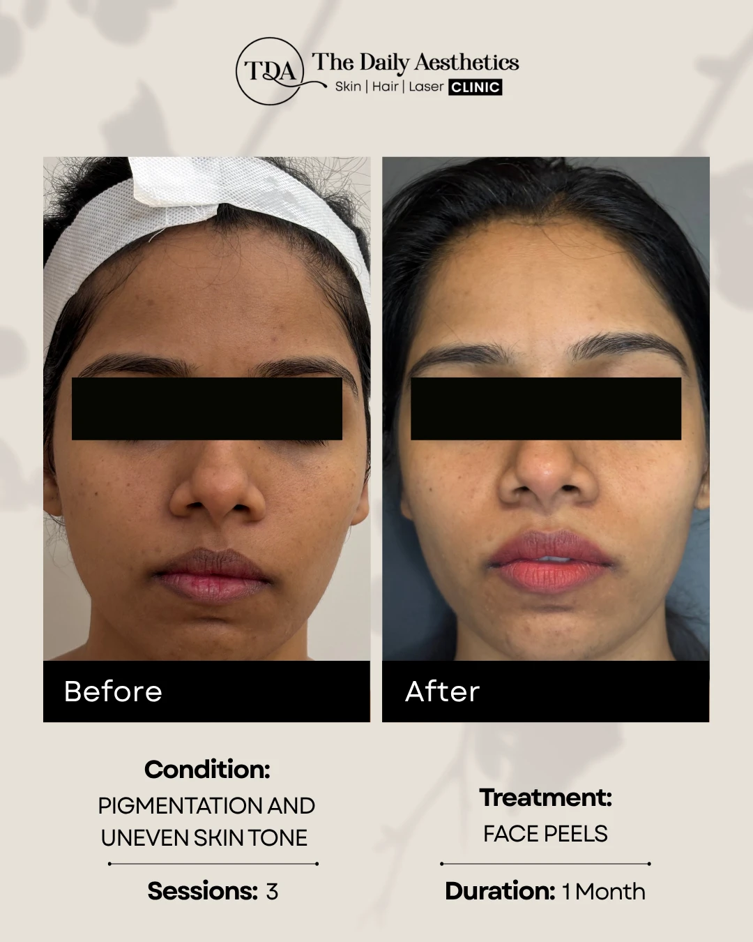 FacePeels (Pigmentation and Uneven Skintone )