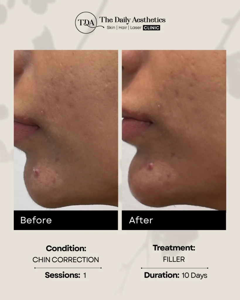 Filler ( Chin Correction )