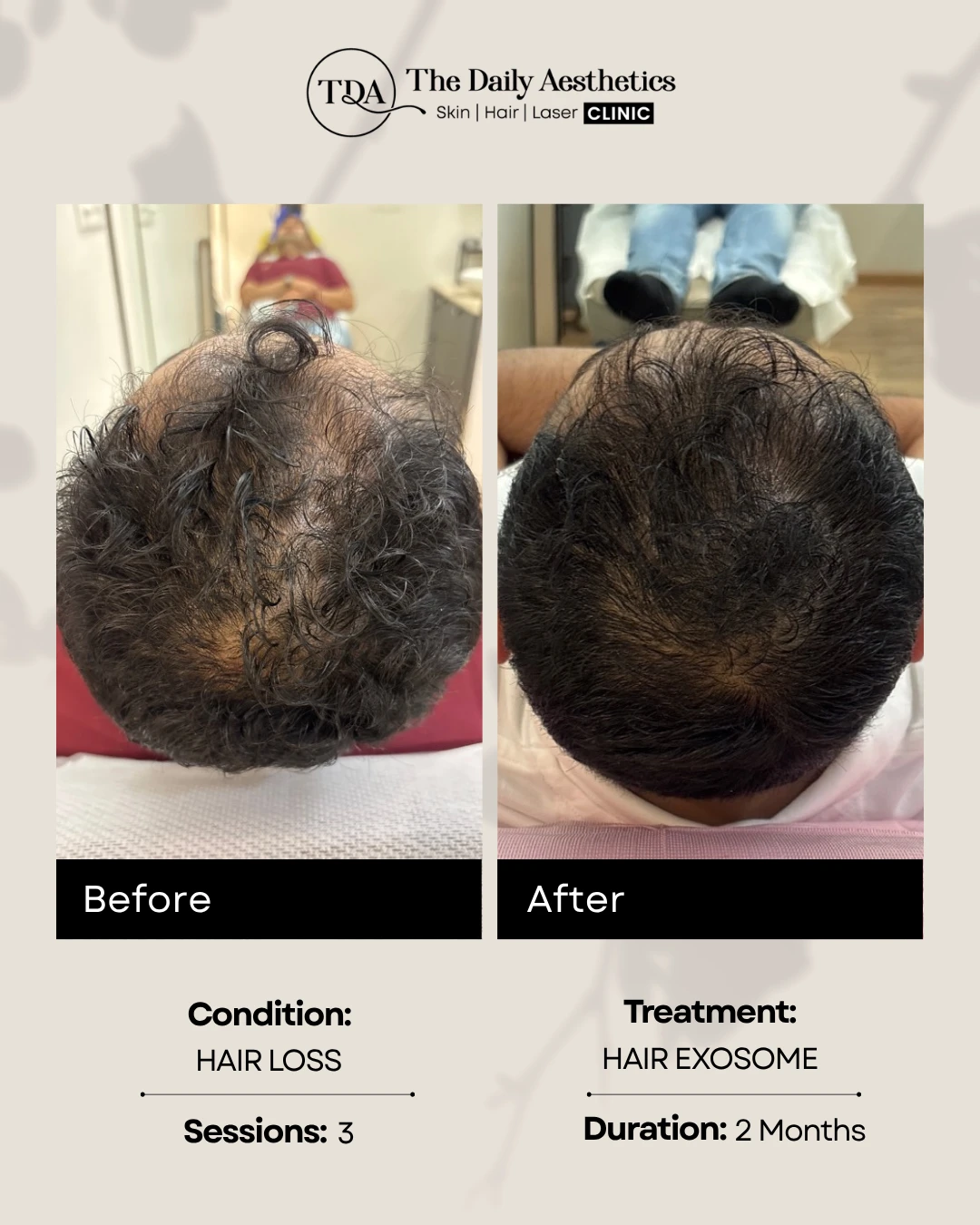 Hair Exosome ( Hairloss )