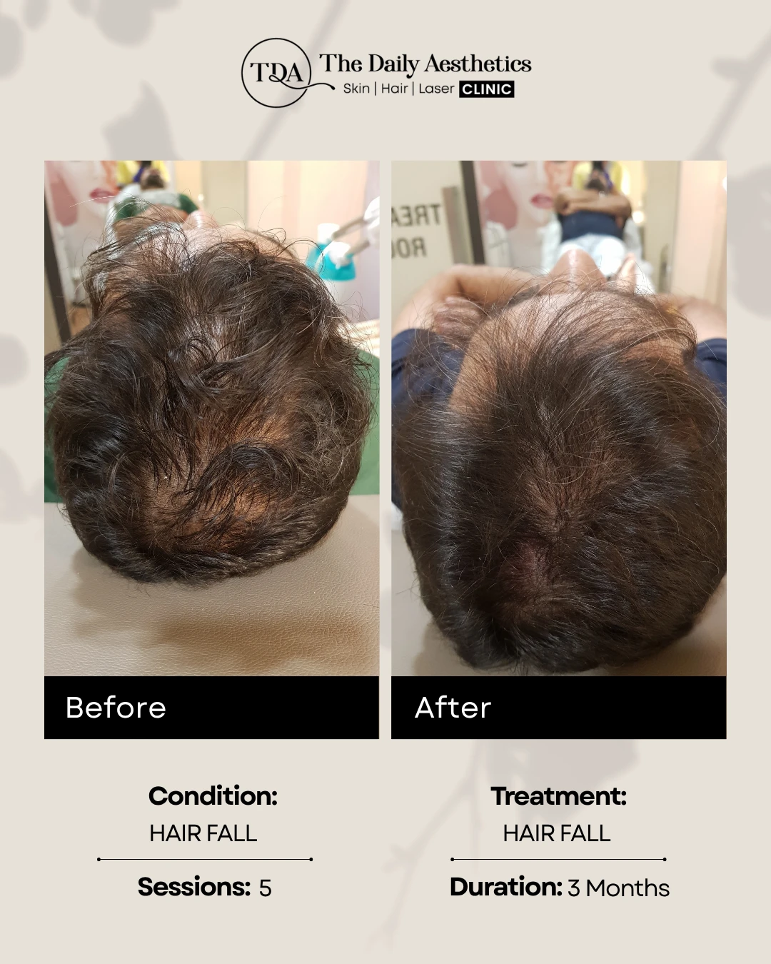 Hair Fall (Hair Fall)