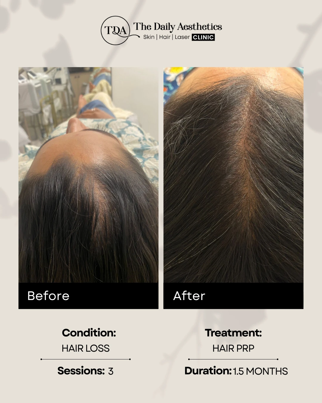 Hair PRP ( Hair Loss )
