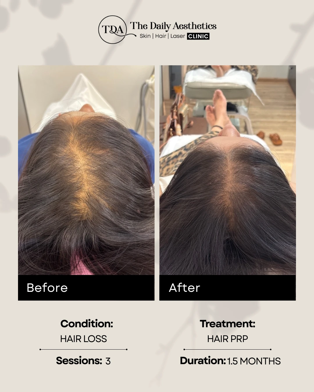 Hair PRP (Hair Loss)