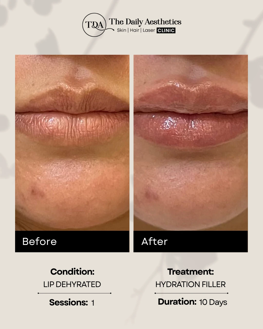 Hydration Filler (Lip Dehydrated)
