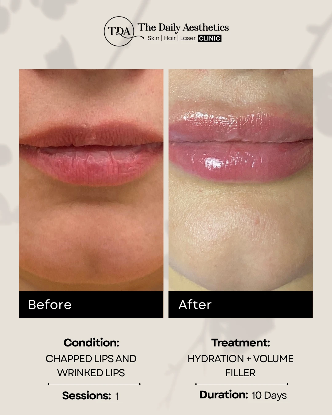Hydration + Volume Filler (Chapped Lips & Wrinked Lips)
